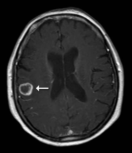 Metástasis cerebral