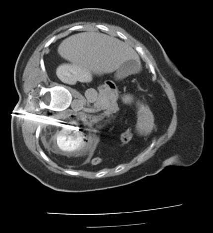 Ablación por radiofrecuencia de un tumor renal.