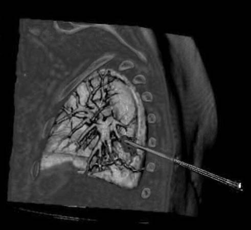 Illustration showing RFA of the lung.