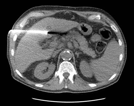 Ablación por radiofrecuencias de un tumor del hígado.