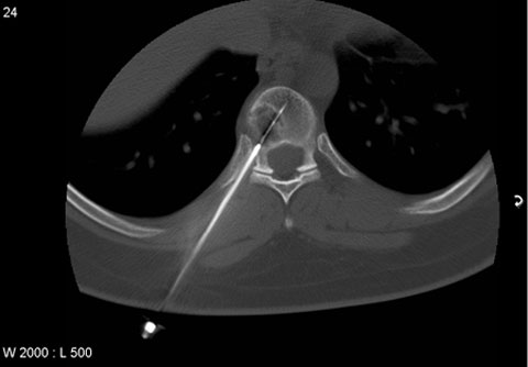 A CT guided needle biopsy