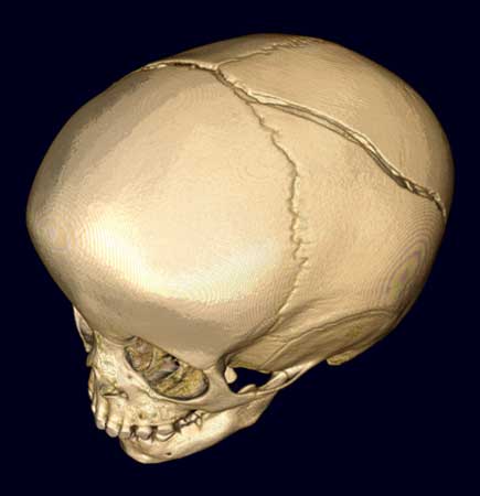 3D image showing a large skull fracture