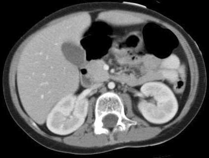  Tomografía computarizada de un abdomen normal