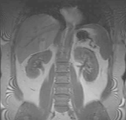 Resonancia magnética abdominal que muestra hígado y riñones