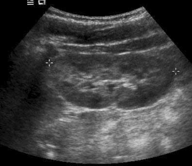 Ultrasound of a normal kidney