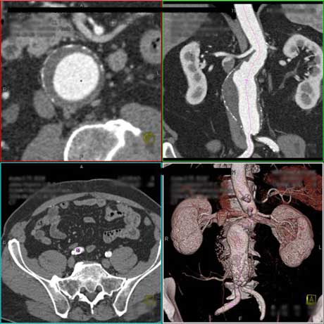 Imágenes 3D de la aorta abdominal