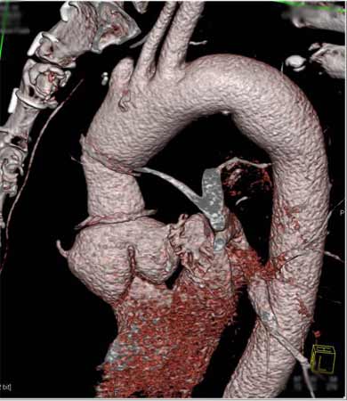 3D CTA image of the aorta