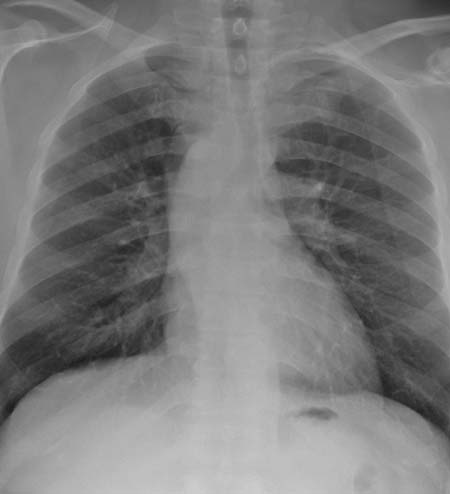 Radiografía de tórax que muestra el arco aórtico