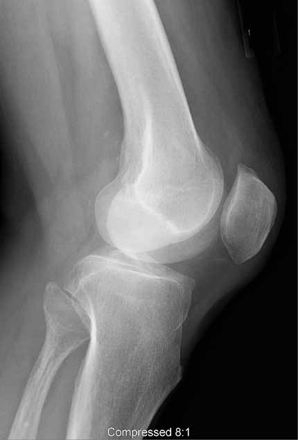 Knee x-ray