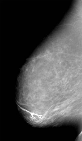 A galactogram showing a papilloma.