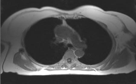 MRI of the chest