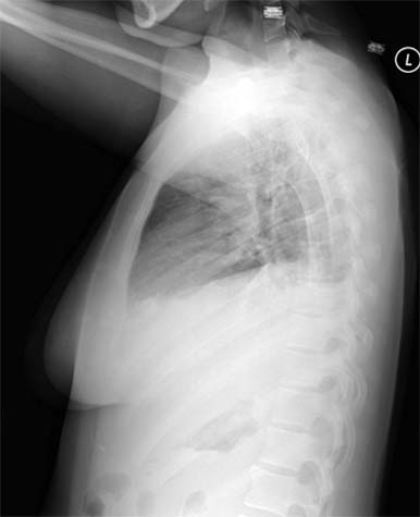 Radiografía de tórax de una paciente con neumonía