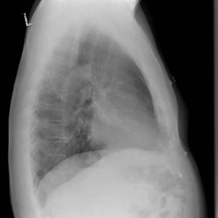 Chest x-ray