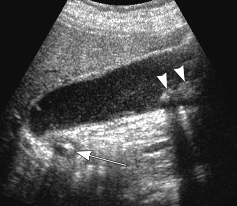 Ultrasound image showing acute cholecystitis.