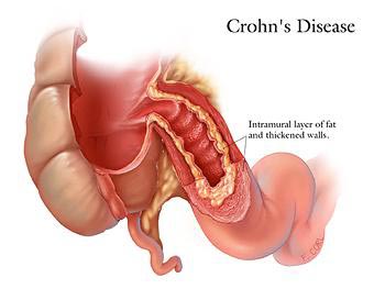 Ilustración de enfermedad de Crohn