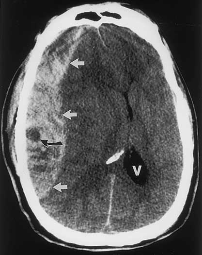 Imagen de tomografía computarizada de la cabeza que muestra un gran coágulo de sangre.