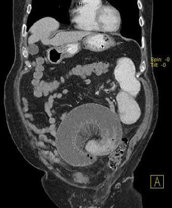 Una imagen de TC que muestra una obstrucción del intestino delgado en asa cerrada