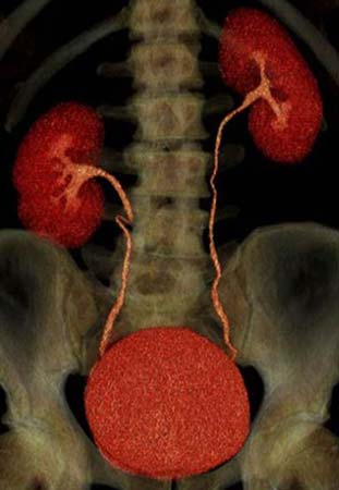 3D urograma por TC de tres fases