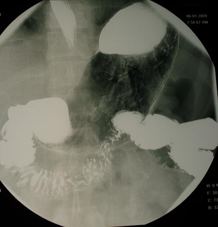 Una imagen de rayos X que muestra el estómago durante un examen gastrointestinal superior