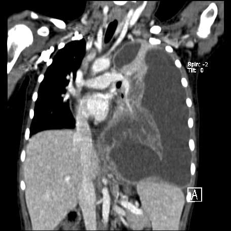 A CT reconstruction of the chest demonstrating a left-sided empyema.