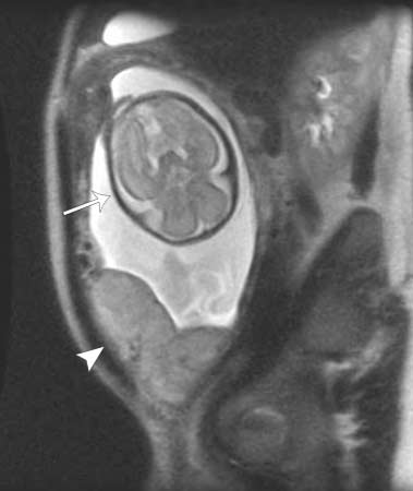 MRI of a pregnant woman showing the baby’s brain