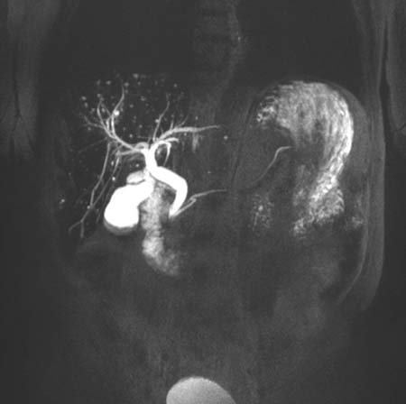 MRCP image of the gallbladder, bile ducts and pancreatic duct