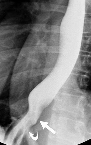 Normal gastroesophageal x-ray. 