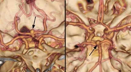 Two different views of a CT brain angiogram