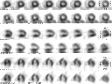 A nuclear medicine heart perfusion scan