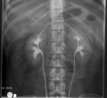 An IVP x-ray image of the upper abdomen 