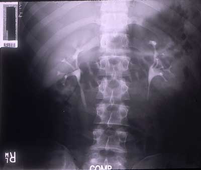 IVP, normal kidneys