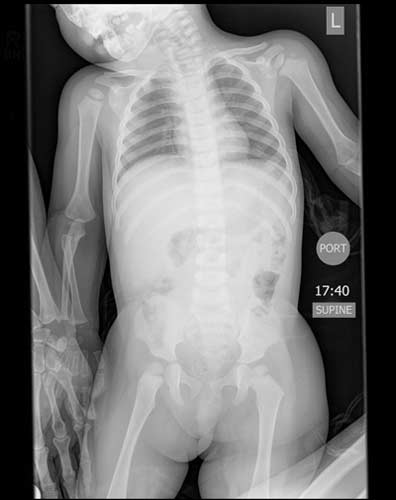 Kiddiegram of a child's chest and abdomen