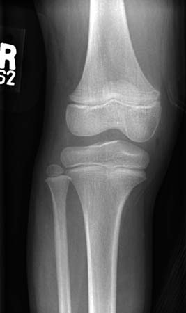 An x-ray of a normal knee in a child (anterior-posterior view)