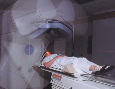 Radiotherapy procedure