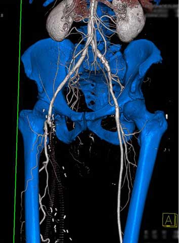 3-D CTA of the lower abdomen.