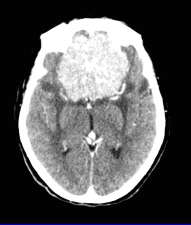 Un examen de TC mostrando un tumor del cerebro no canceroso.