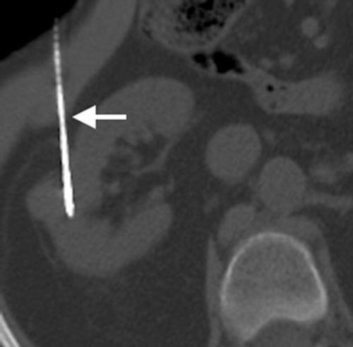 MRI showing microwave applicators.