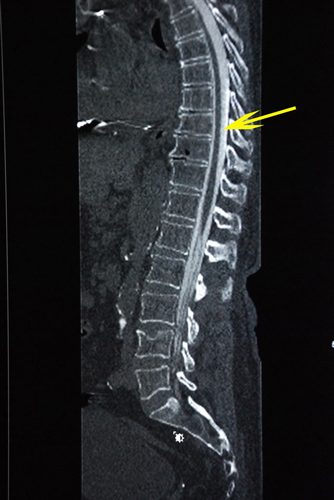 CT scan of the dural tube.