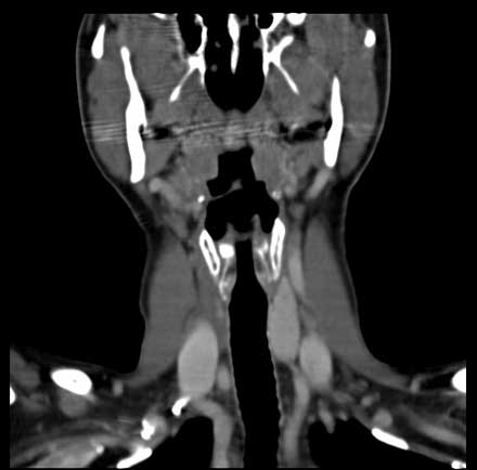 CT of the neck, 'reconstructed' from a series of cross sections.