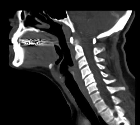 CT - Normal sagittal section of the neck in the midline, 'reconstructed' from a series of cross-sections.