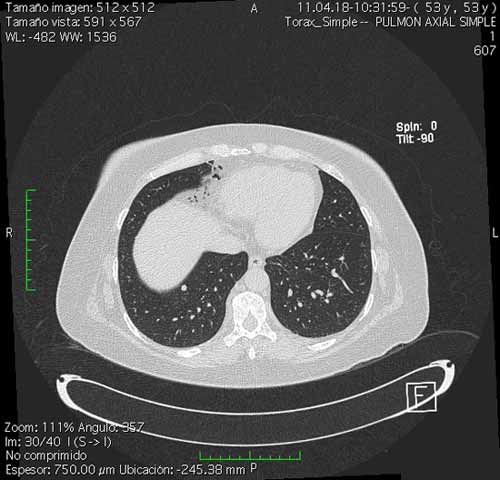 CT image showing a pulmonary (lung) nodule.