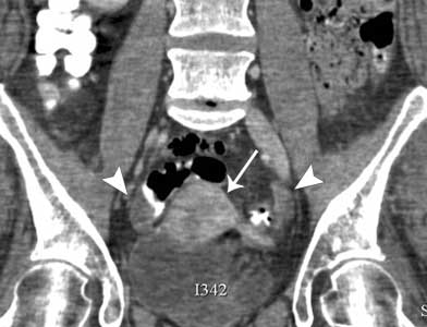 Imagen de tomografía computarizada de la pelvis de una mujer que muestra el útero y los ovarios.