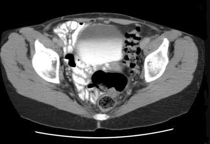 TC pélvica que muestra contraste en el intestino delgado y la vejiga urinaria. 