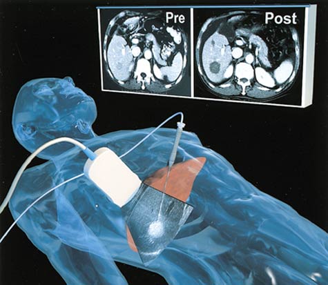 Computer-generated image depicts the elements of ultrasound-guided percutaneous ablation of liver tumors.