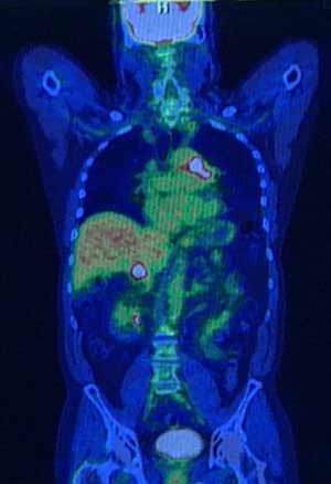 Exploración PET/CT del cuerpo