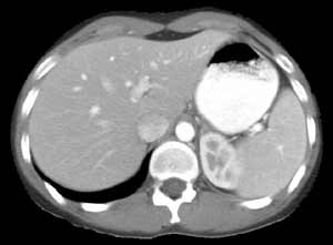 Image taken from a CT scan of the liver.