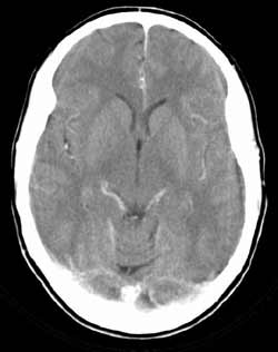 Image taken during a head CT scan.