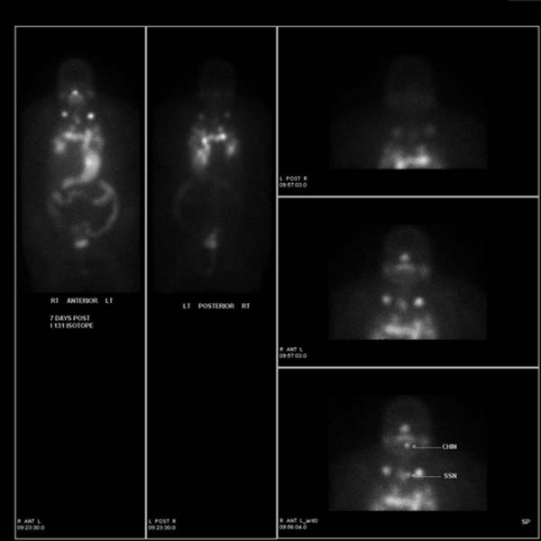 I-123 diagnostic whole body images demonstrate no abnormal focus of activity to suggest metastasis. I-131 post treatment whole body images demonstrate multiple abnormal foci of activities consistent with extensive cervical lymph nodes and pulmonary metastases. These findings confirmed by subsequent CT images.