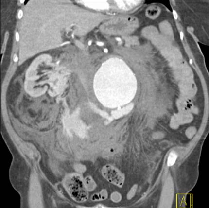 Tomografía computarizada: aorta abdominal rota.