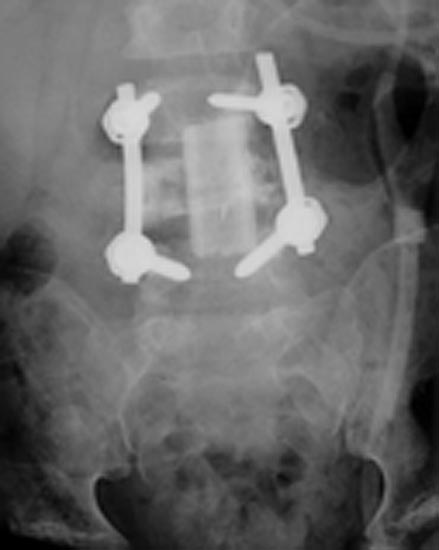 Frontal X-ray of the lumbar spine showing pedicle screws with spanning rods on each side.